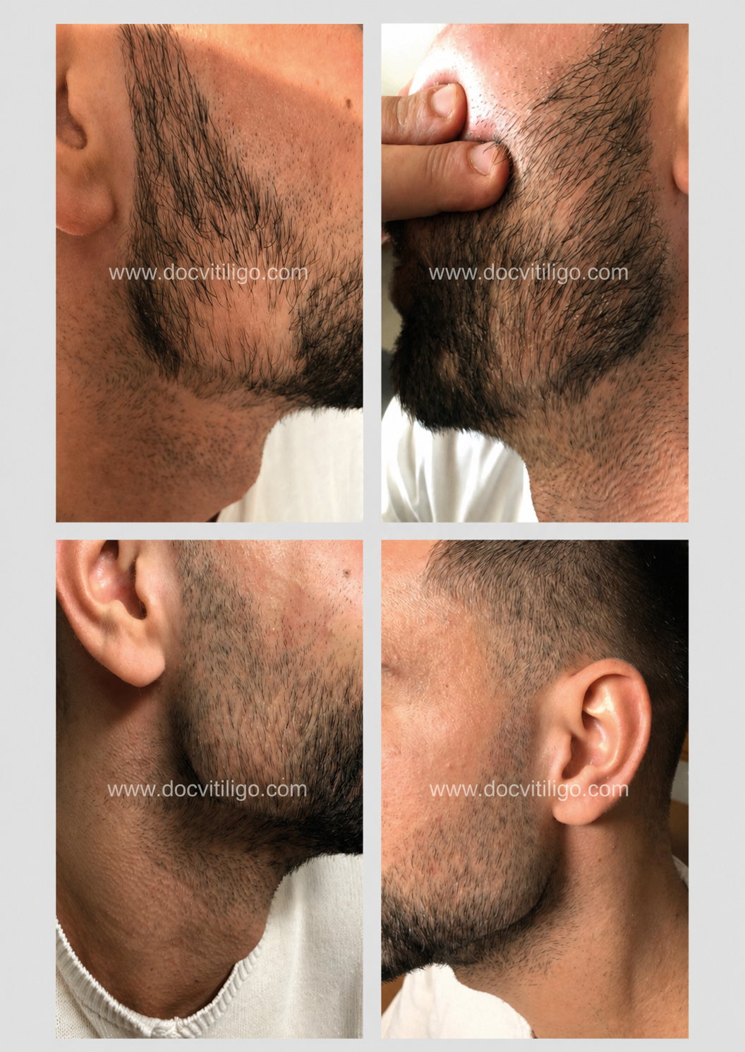 Caso 3 — ripigmentazione area barba